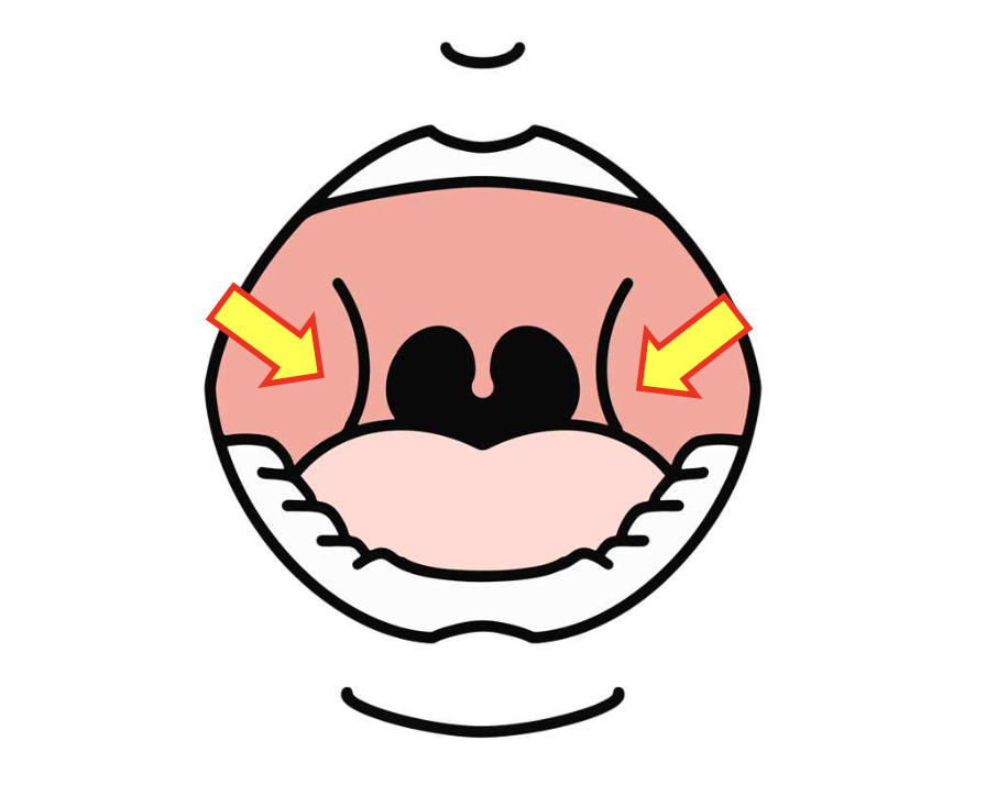 慢性扁桃炎とは何ですか?